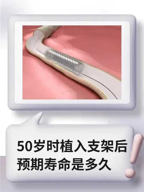药物洗脱支架寿命评估及临床耐久性分析