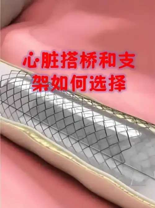 心脏介入专家支架类型选择建议指南 心脏 介入 专家 支架 类型 选择 建议 指南 第1张 心脏介入专家支架类型选择建议指南 心脏 介入 专家 支架 类型 选择 建议 指南 第1张